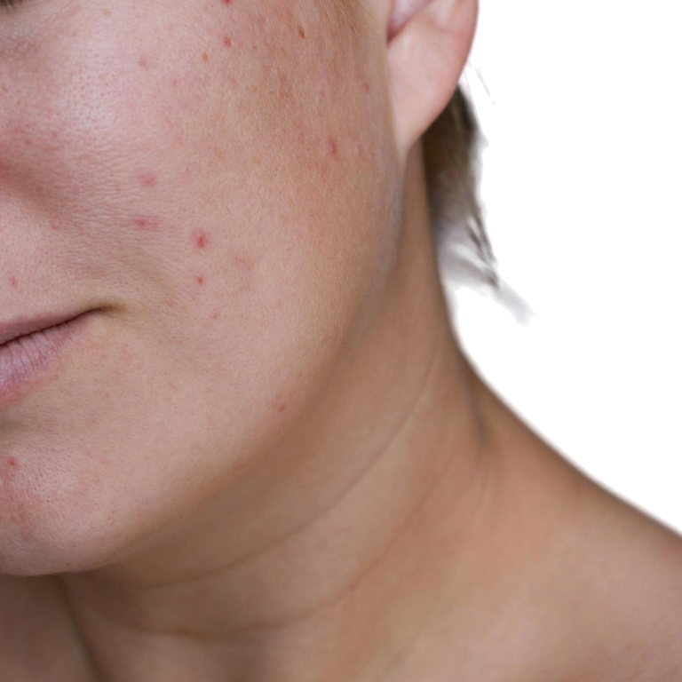 cicatrizarse-mujer-natural-mal-acne-piel-cicatrices