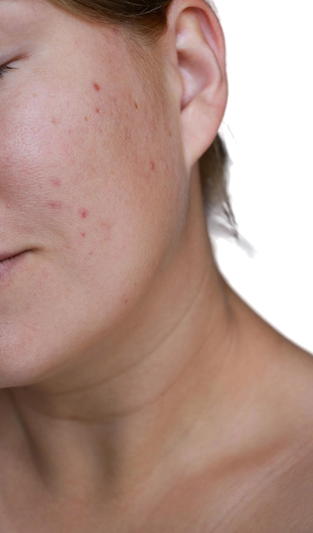 cicatrizarse-mujer-natural-mal-acne-piel-cicatrices