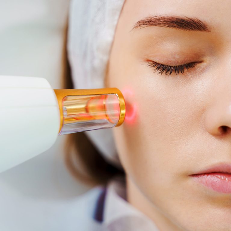Removal of small vessels on patient face with laser equipment. Laser treatment of rosacea with IPL equipment by beautician