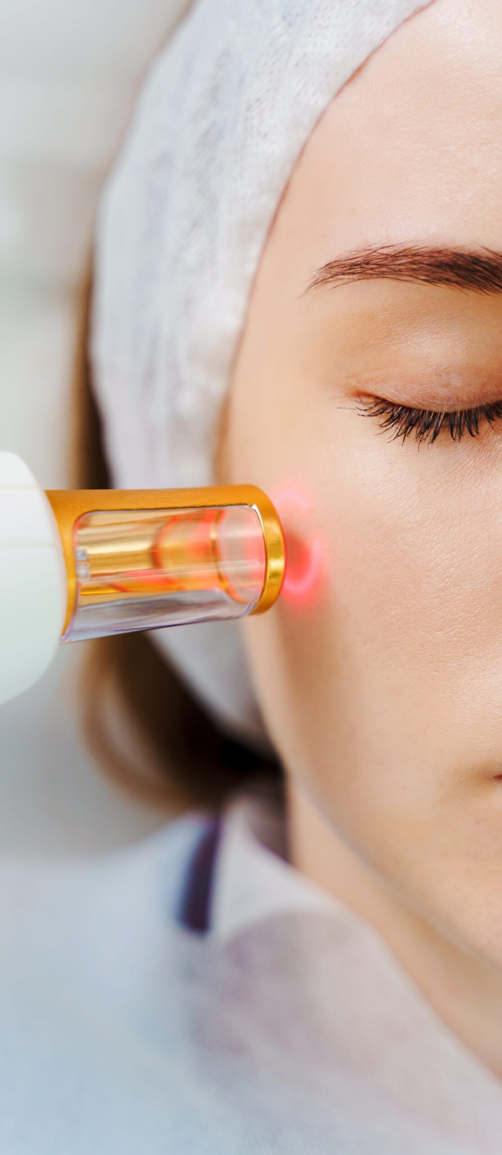 Removal of small vessels on patient face with laser equipment. Laser treatment of rosacea with IPL equipment by beautician