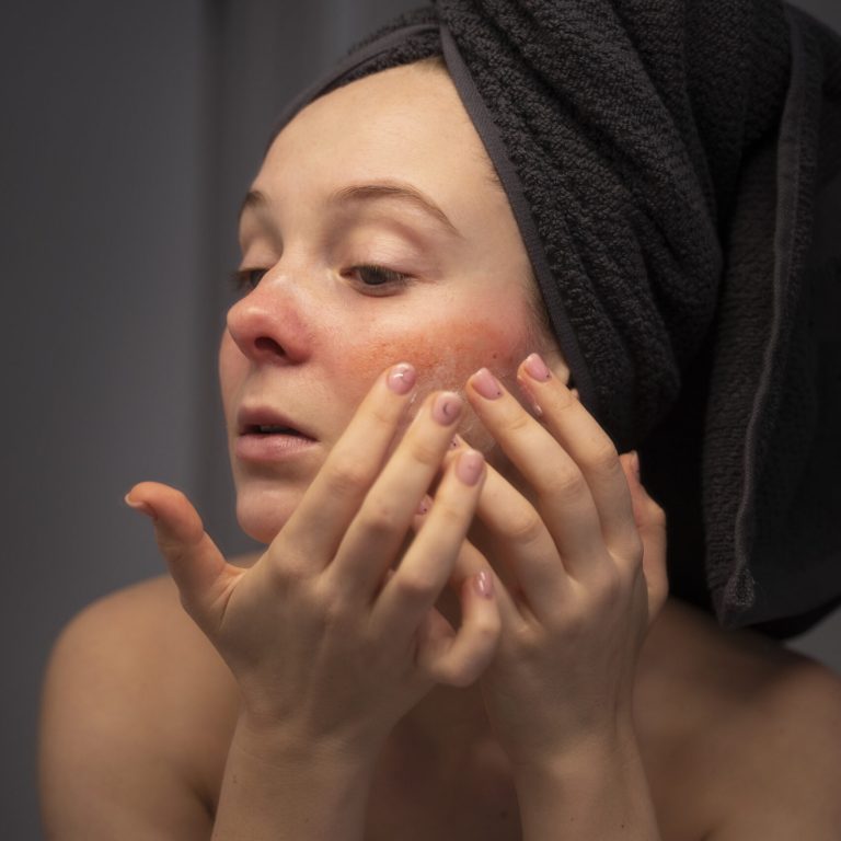mujer-mirando-su-rosacea-en-el-espejo