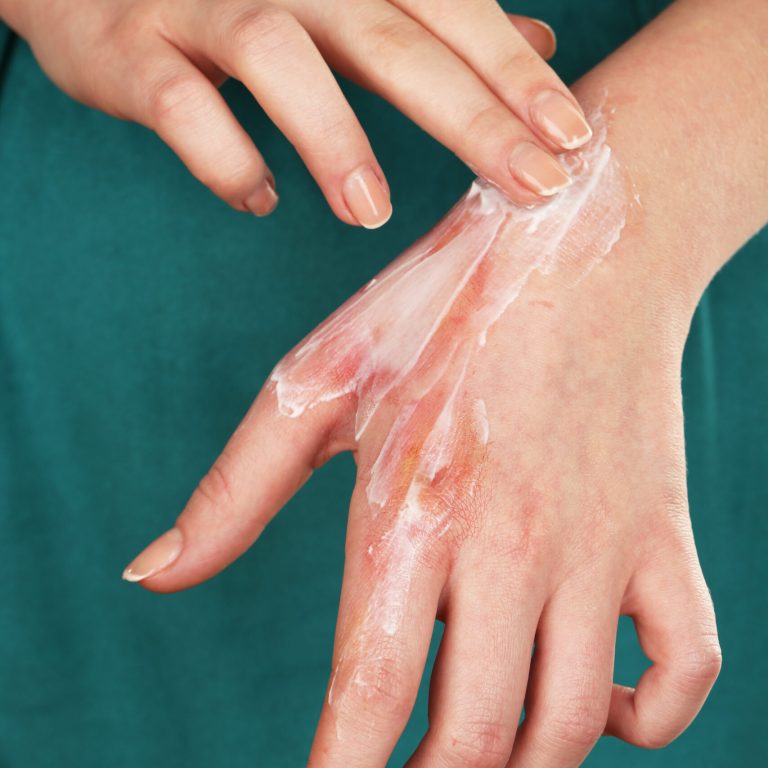 Treatment of burns on female hand, closeup
